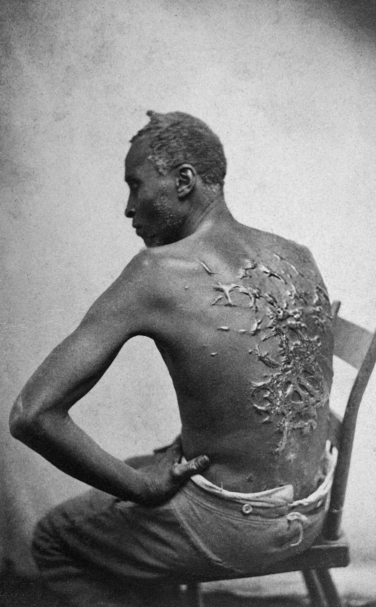 Photograph of an African American man whose back is covered in scars.